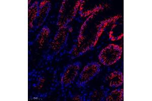 Immunofluorescence of paraffin embedded human colon cancer using MRP1 (ABIN7074544) at dilution of 1:1000 (250x lens) (MRP1 抗体)