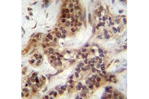 FOXA2 antibody immunohistochemistry analysis in formalin fixed and paraffin embedded human bladder carcinoma. (FOXA2 抗体  (AA 134-163))