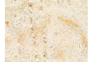 ABIN6262433 and ABIN6277655 at 1/100 staining human tongue carcinoma by IHC-P.