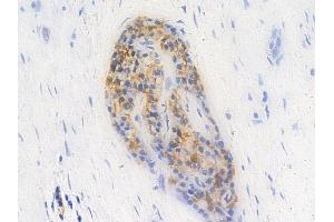 ABIN6256558 and ABIN6267613 at 1/100 staining human pancreatic carcinoma by IHC-P.