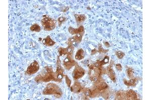 Formalin-fixed, paraffin-embedded human Hepatocellular Carcinoma stained with Serum Amyloid A Mouse Monoclonal Antibody (SAA/326). (SAA 抗体)