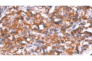 Immunohistochemistry of paraffin-embedded Human thyroid cancer using GH1 Polyclonal Antibody at dilution of 1:40 (Growth Hormone 1 抗体)