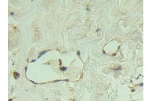 Detection of P-cadherin in Human Breast cancer Tissue using Polyclonal Antibody to Placental Cadherin (P-cadherin) (P-Cadherin 抗体  (AA 371-660))