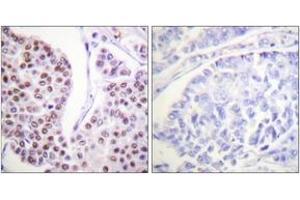 Immunohistochemistry analysis of paraffin-embedded human breast carcinoma tissue, using Histone H4 (Ab-8) Antibody.