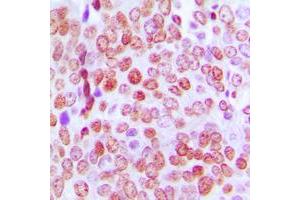 Immunohistochemical analysis of TCF4/12 staining in human prostate cancer formalin fixed paraffin embedded tissue section. (TCF4/12 (C-Term) 抗体)