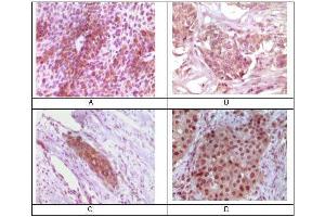 Immunohistochemical analysis of paraffin-embedded human bladder carcinoma (A), breast carcinoma (B), esophagus carcinoma (C), skin carcinoma (D) tissue, showing cytoplasmic localization using Rab25 mouse mAb with DAB staining.