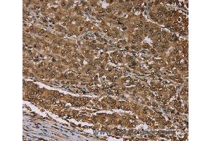 Immunohistochemistry of Human thyroid cancer using MEIS1 Polyclonal Antibody at dilution of 1:30 (MEIS1 抗体)