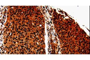 Immunohistochemistry of paraffin-embedded Human renal cancer tissue using ANXA7 Polyclonal Antibody at dilution 1:40 (Annexin VII 抗体)