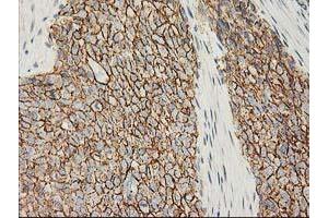 Immunohistochemical staining of paraffin-embedded Adenocarcinoma of Human breast tissue using anti-CTNNB1 mouse monoclonal antibody. (CTNNB1 抗体)