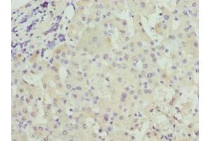 Immunohistochemistry of paraffin-embedded human liver cancer using ABIN7146036 at dilution of 1:100 (CRP 抗体  (AA 19-224))