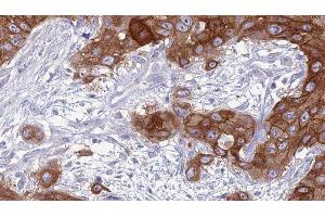 ABIN6277037 at 1/100 staining Human Head and neck cancer tissue by IHC-P. (CD83 抗体  (Internal Region))