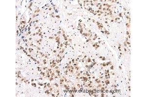 Immunohistochemistry of Human prostate cancer using CTBP2 Polyclonal Antibody at dilution of 1:40 (CTBP2 抗体)