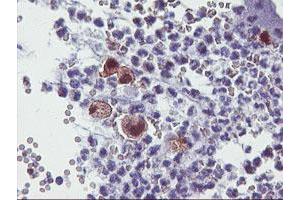 Immunohistochemical staining of paraffin-embedded Adenocarcinoma of Human colon tissue using anti-SDS mouse monoclonal antibody. (serine Dehydratase 抗体)