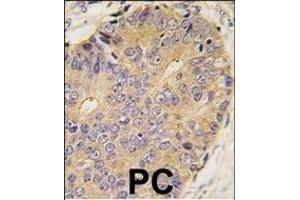 Formalin-fixed and paraffin-embedded human prostata carcinoma tissue reacted with B antibody (Center) (ABIN388450 and ABIN2848765) , which was peroxidase-conjugated to the secondary antibody, followed by DAB staining. (BMP15 抗体  (AA 241-271))