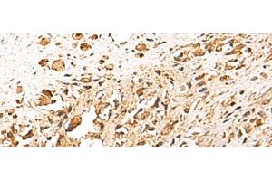 Immunohistochemistry of paraffin-embedded Human prost ate cancer tissue using TERF1 Polyclonal Antibody at dilution of 1:30(x200) (TRF1 抗体)