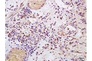 Formalin-fixed and paraffin embedded human bladder carcinoma labeled with Anti-CD158 Polyclonal Antibody, Unconjugated (ABIN748463) at 1:200 followed by conjugation to the secondary antibody and DAB staining. (KIR2DL4/CD158d 抗体  (AA 51-150))