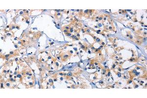 Immunohistochemistry of paraffin-embedded Human thyroid cancer using CAPZA2 Polyclonal Antibody at dilution of 1:30 (CAPZA2 抗体)