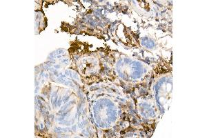 Immunohistochemistry of paraffin-embedded Human colon carcinoma using Human IgG antibody (ABIN7267844) at dilution of 1:300 (40x lens). (IGHG1 抗体)