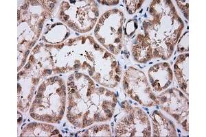 Immunohistochemical staining of paraffin-embedded Carcinoma of liver tissue using anti-NME4 mouse monoclonal antibody. (NME4 抗体)