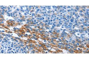 Immunohistochemistry of paraffin-embedded Human ovarian cancer tissue using PAK6 Polyclonal Antibody at dilution 1:40