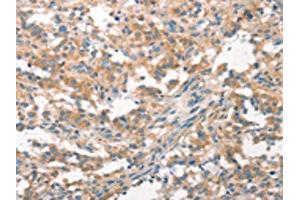 The image on the left is immunohistochemistry of paraffin-embedded Human thyroid cancer tissue using ABIN7193053(WNK3 Antibody) at dilution 1/20, on the right is treated with synthetic peptide. (WNK3 抗体)
