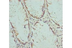 Immunohistochemistry of paraffin-embedded human colon cancer using ABIN7148459 at dilution of 1:100 (COG5 抗体  (AA 1-260))