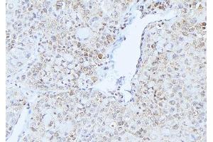 ABIN6275233 at 1/100 staining Human lung cancer tissue by IHC-P. (MRPS21 抗体  (C-Term))