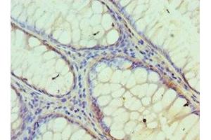 Immunohistochemistry of paraffin-embedded human colon cancer using ABIN7157125 at dilution of 1:100 (IDH2 抗体  (AA 193-452))