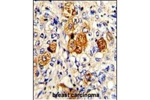 Formalin-fixed and paraffin-embedded human breast carcinoma with C5 Antibody (N-term), which was peroxidase-conjugated to the secondary antibody, followed by DAB staining.