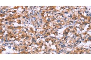 Immunohistochemistry of paraffin-embedded Human thyroid cancer tissue using BRK1 Polyclonal Antibody at dilution 1:30 (BRK1 抗体)