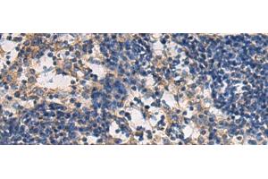 Immunohistochemistry of paraffin-embedded Human esophagus cancer tissue using DMRTA2 Polyclonal Antibody at dilution of 1:50(x200) (DMRTA2 抗体)