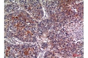 Immunohistochemistry (IHC) analysis of paraffin-embedded Human Lung, antibody was diluted at 1:100. (IL13RA2 抗体  (Internal Region))