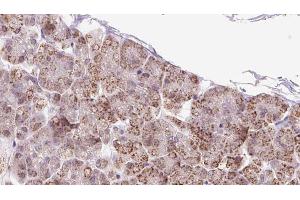 ABIN6273246 at 1/100 staining Human pancreas cancer tissue by IHC-P. (FXR1 抗体  (Internal Region))