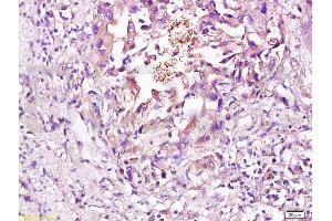 Formalin-fixed and paraffin embedded human esophageal carcinoma labeled with Rabbit Anti CD56/NCAM1 Polyclonal Antibody, Unconjugated (ABIN728398) at 1:200 followed by conjugation to the secondary antibody and DAB staining (CD56 抗体  (AA 621-720))