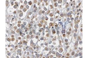 ABIN6268680 at 1/100 staining human breast tissues sections by IHC-P. (alpha Fetoprotein 抗体  (C-Term))