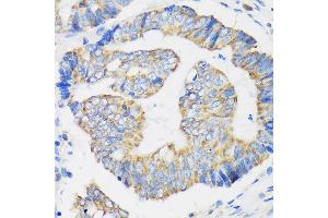 Immunohistochemistry of paraffin-embedded Human colon carcinoma using RPL35 Rabbit pAb (ABIN7270004) at dilution of 1:100 (40x lens). (RPL35 抗体  (AA 50-120))