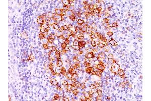 Formalin-fixed, paraffin-embedded human Hodgkin's lymphoma stained with CD30 Ab (CD30/412). (TNFRSF8 抗体)