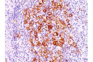 Formalin-fixed, paraffin-embedded human Hodgkin's lymphoma stained with CD30 Ab (CD30/412).