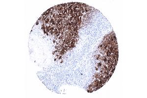 Follicular thyroid cancer with strong thyroglobulin expression (Recombinant Thyroglobulin 抗体)