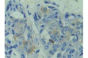 Detection of CAPS in Human Breast cancer Tissue using Polyclonal Antibody to Calcyphosine (CAPS) (Calcyphosine 抗体  (AA 1-189))