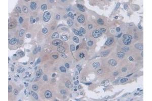 DAB staining on IHC-P; Samples: Human Breast cancer Tissue (FAM3B 抗体  (AA 30-187))