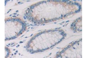 DAB staining on IHC-P; Samples: Human Colorectal cancer Tissue (Ribonuclease A10 (AA 27-216) 抗体)