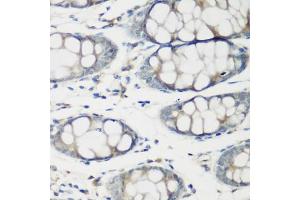 Immunohistochemistry of paraffin-embedded human colon using TNNC2 antibody (ABIN6129604, ABIN6149353, ABIN6149354 and ABIN6223680) at dilution of 1:200 (40x lens). (TNNC2 抗体  (AA 1-160))