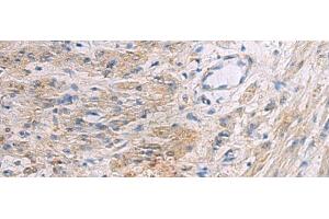 Immunohistochemistry of paraffin-embedded Human gastric cancer tissue using SLC30A3 Polyclonal Antibody at dilution of 1:55(x200) (Slc30a3 抗体)