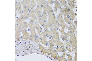 Immunohistochemistry of paraffin-embedded human liver injury using NSF antibody (ABIN5974702) at dilution of 1/100 (40x lens). (NSF 抗体)