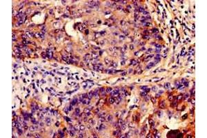 Immunohistochemistry analysis of human cervical cancer using ABIN7156687 at dilution of 1:100