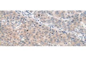 Immunohistochemistry of paraffin-embedded Human liver cancer tissue using SEMA4D Polyclonal Antibody at dilution of 1:60(x200) (SEMA4D/CD100 抗体)