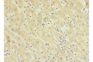 Immunohistochemistry of paraffin-embedded human liver cancer using ABIN7173293 at dilution of 1:100 (TMEM91 抗体  (AA 1-97))