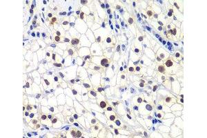 Immunohistochemistry of paraffin-embedded Human kidney cancer using GTF2F2 Polyclonal Antibody at dilution of 1:200 (40x lens). (GTF2F2 抗体)