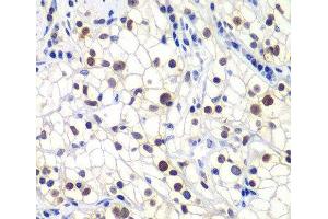 Immunohistochemistry of paraffin-embedded Human kidney cancer using GTF2F2 Polyclonal Antibody at dilution of 1:200 (40x lens). (GTF2F2 抗体)